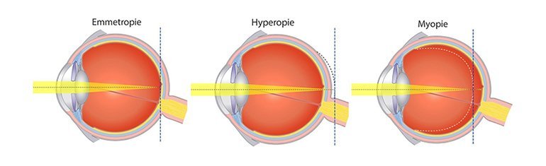 myopie hyperopie astigmatismus